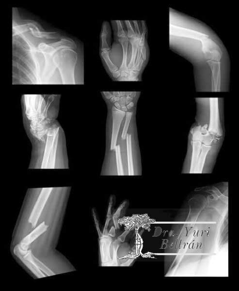 Necesito-cirugia-si-sufro-una-fractura-osea